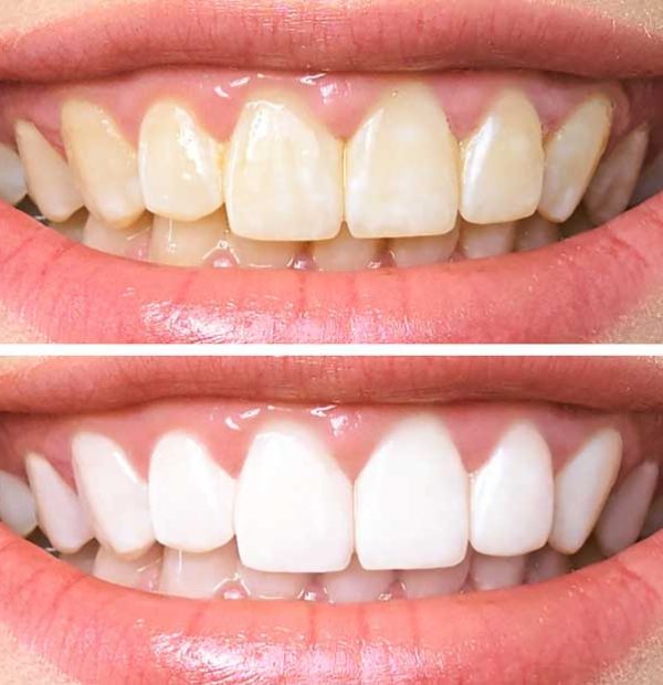 Teeth-Whitening-Before-and-After-Example